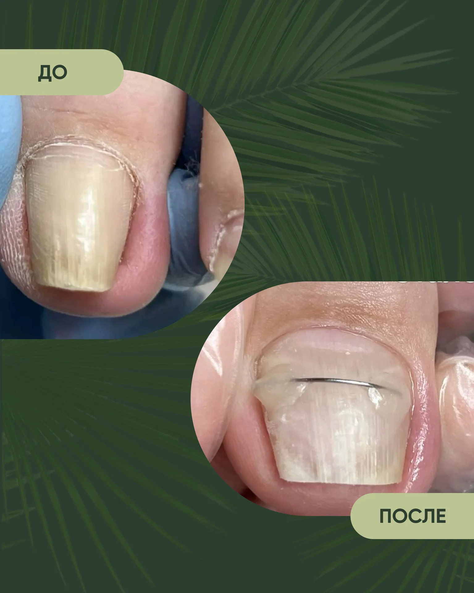 Подолог педикюр - миниатюра 7