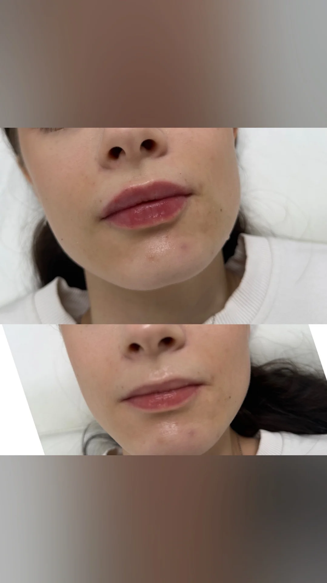 Увеличение губ - изображение 1