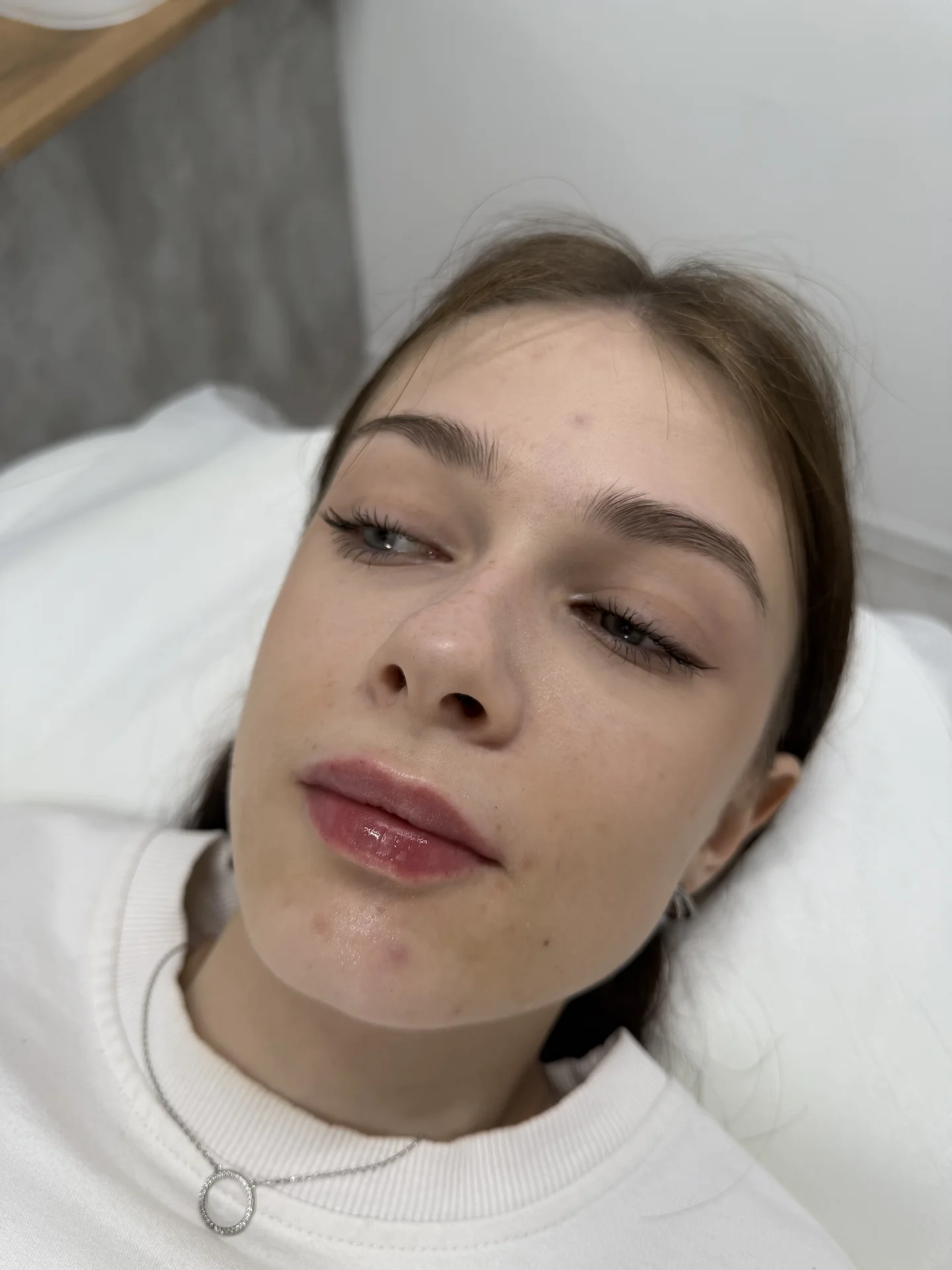Увеличение губ - миниатюра 3