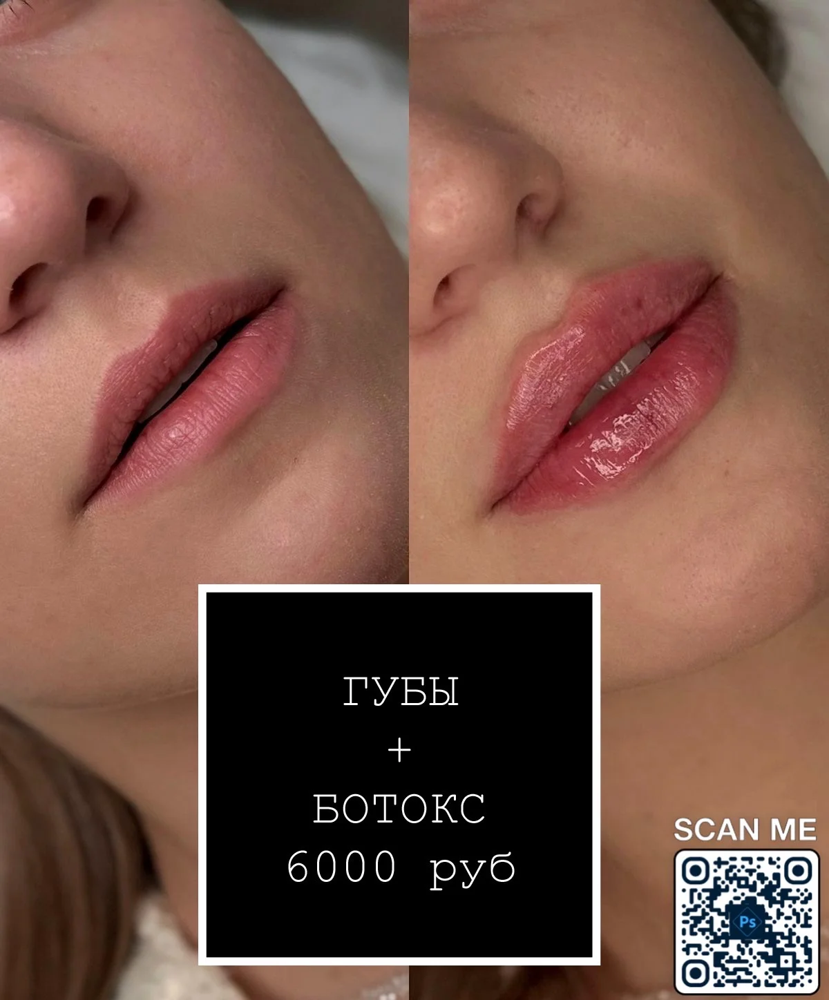 увеличение губ+ ботокс 3 зоны - изображение 1