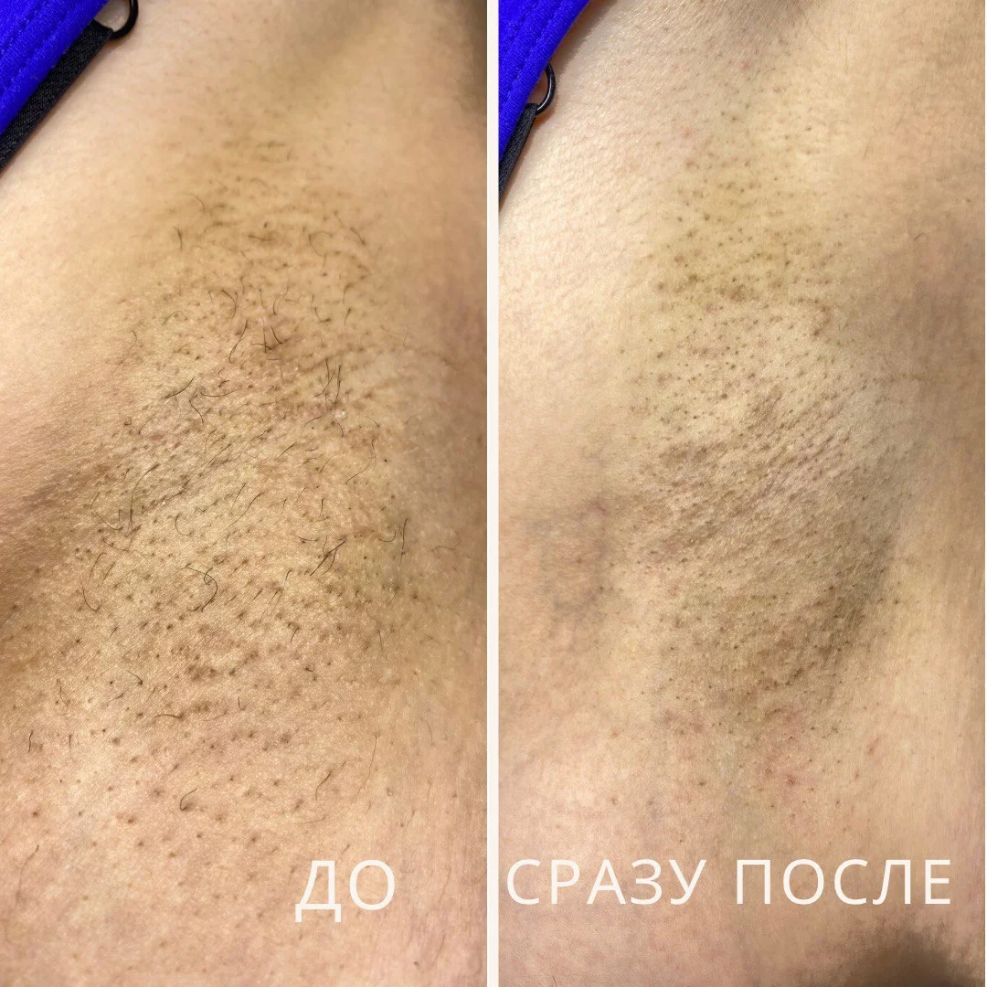 Электроэпиляция Москва Павелецкая - миниатюра 20