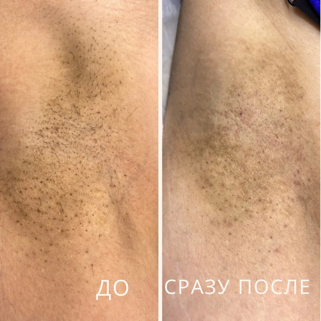 Электроэпиляция Москва Павелецкая - миниатюра 26