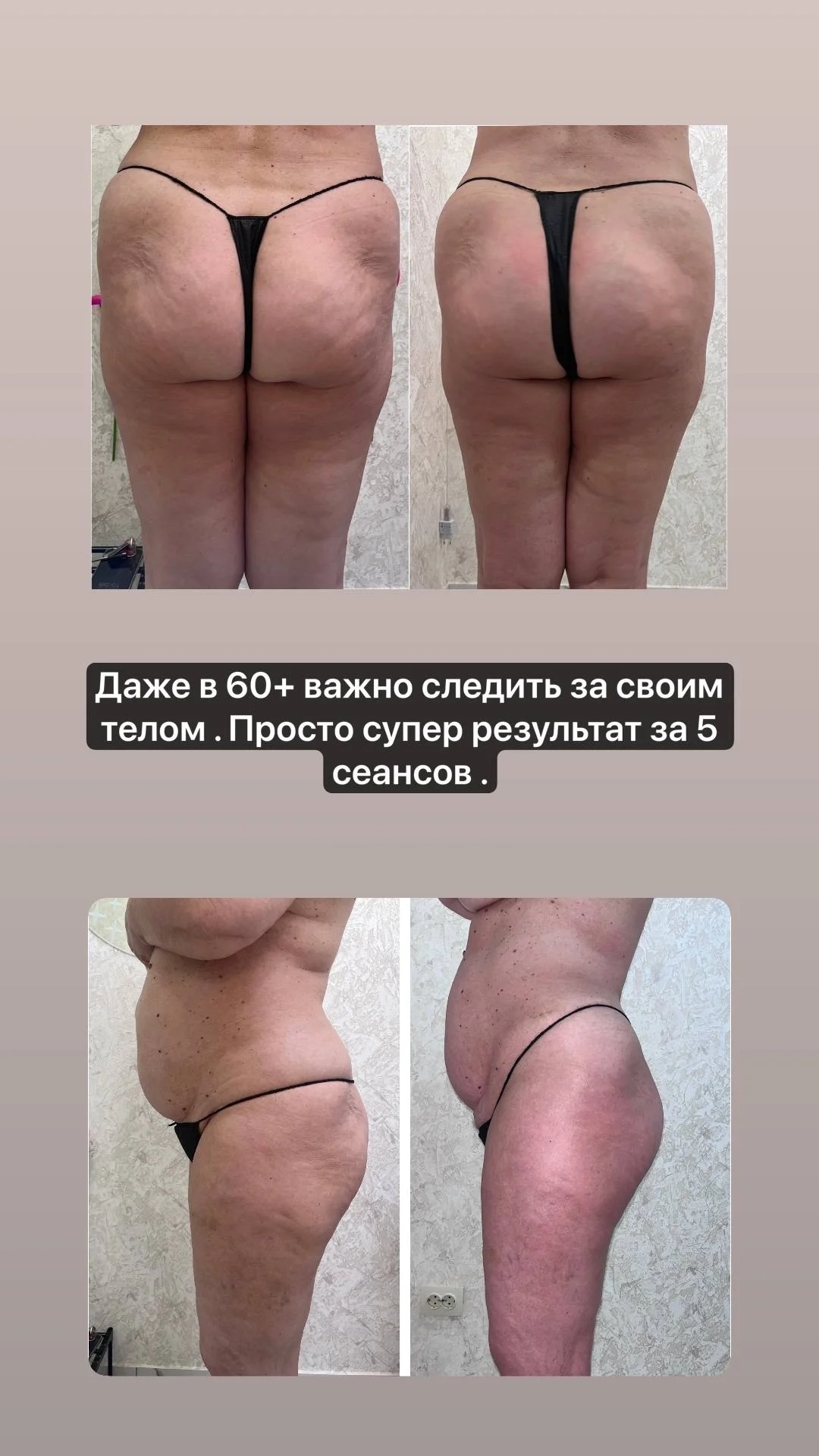 Антицеллюлитный массаж - миниатюра 5