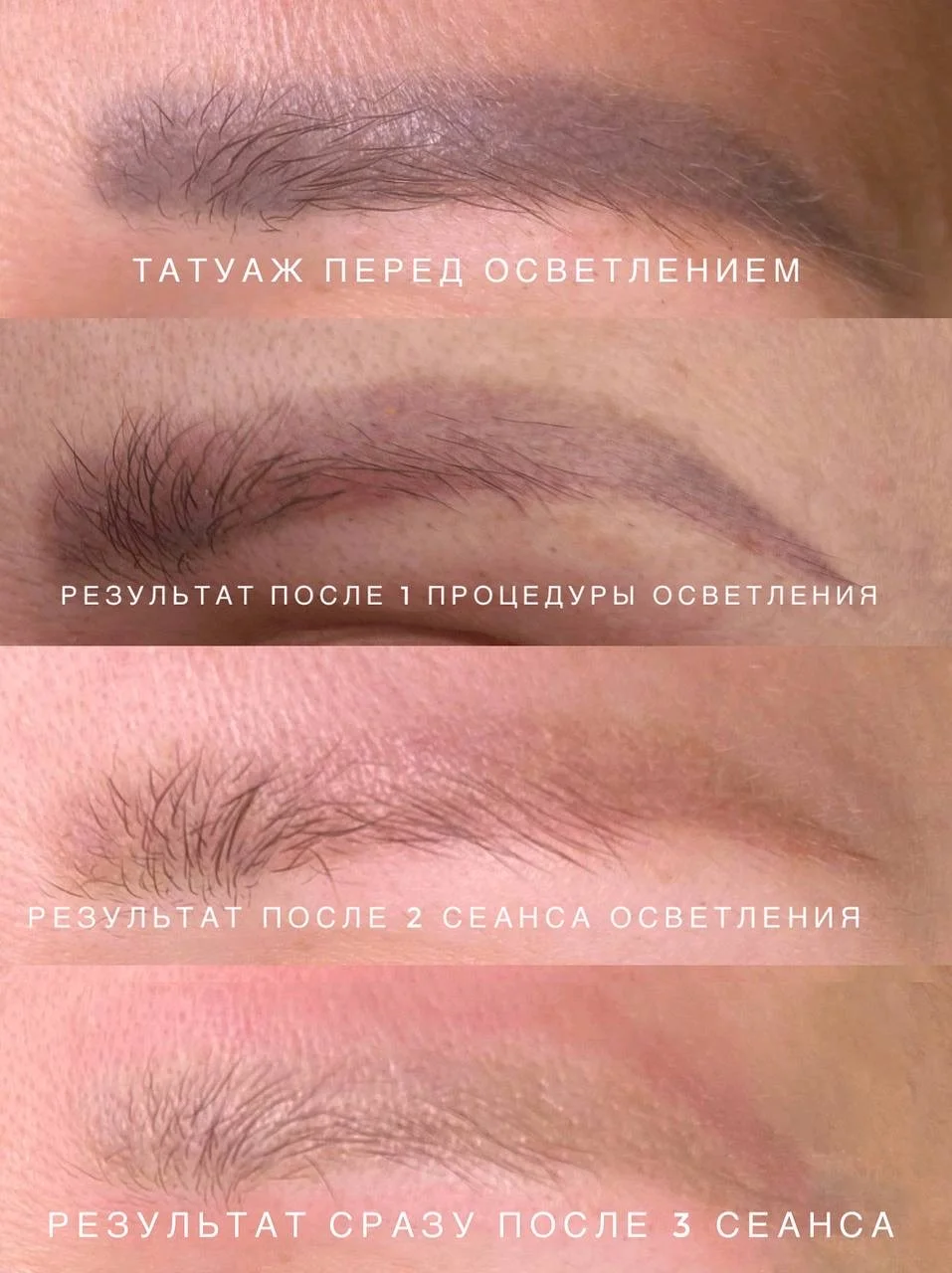 Удаление татуажа (татуировок) - миниатюра 6