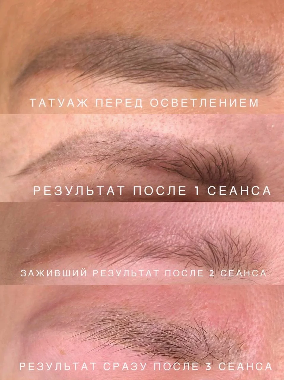 Удаление татуажа (татуировок) - миниатюра 7