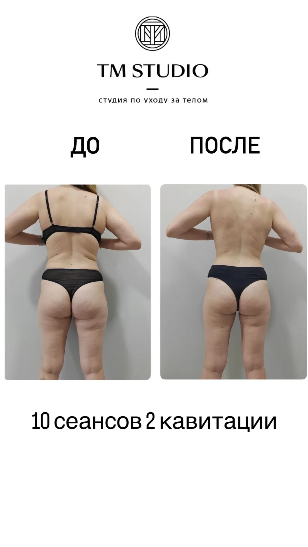 Массаж коррекционный антицеллюлитный - миниатюра 2