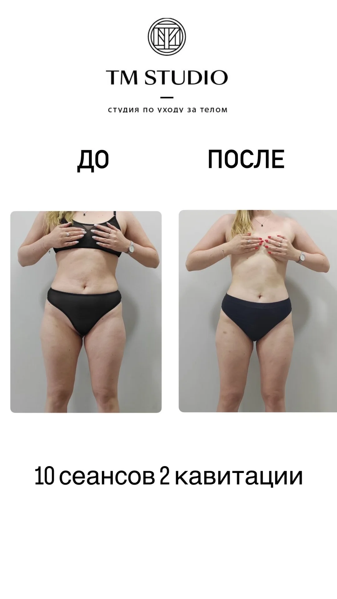 Массаж коррекционный антицеллюлитный - миниатюра 3