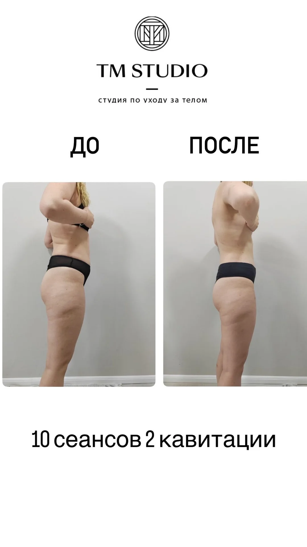 Массаж коррекционный антицеллюлитный - миниатюра 4