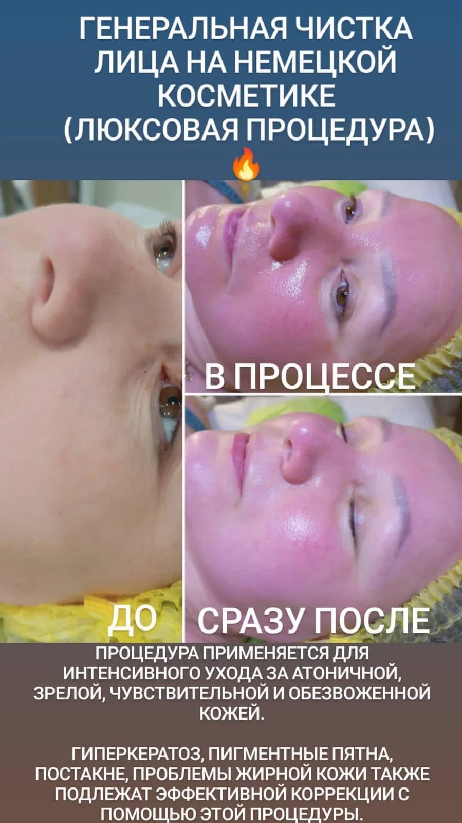 Косметолог: прыщи(акне), пигментация, чистка - миниатюра 14