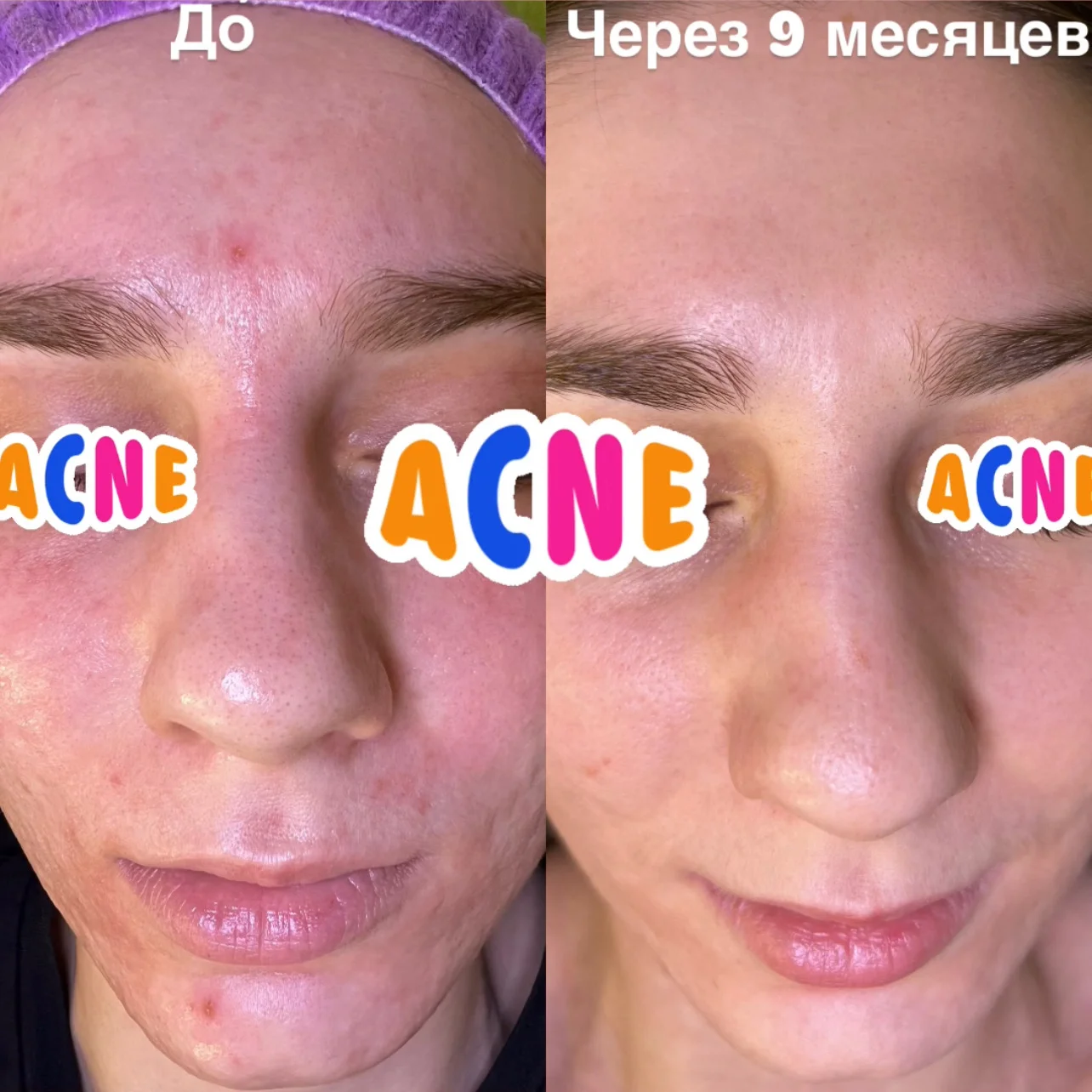 Косметолог: прыщи(акне), пигментация, чистка - миниатюра 25