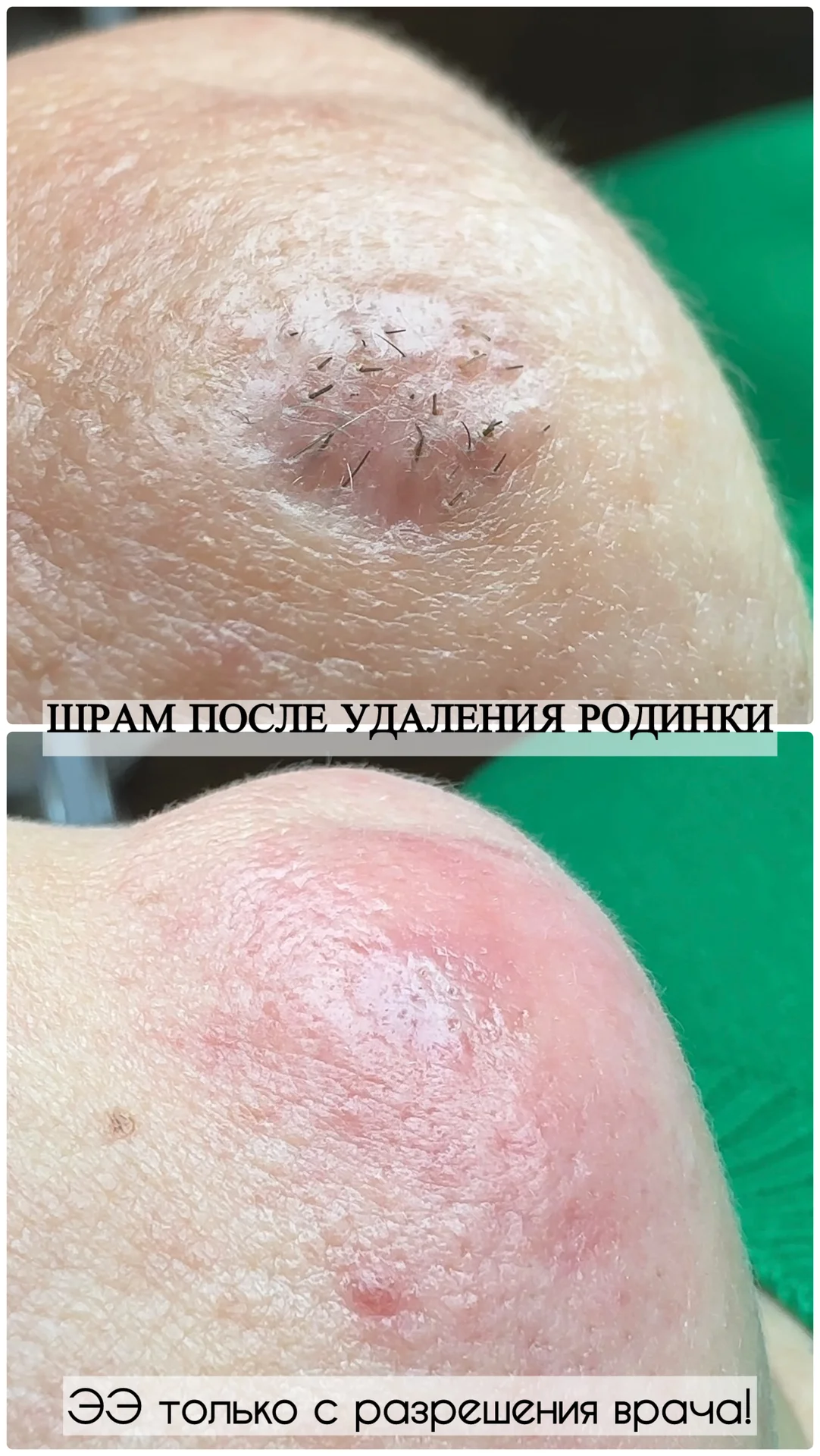 Электроэпиляция - миниатюра 9