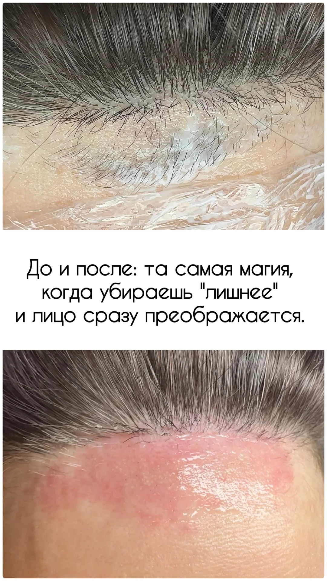 Электроэпиляция - миниатюра 10