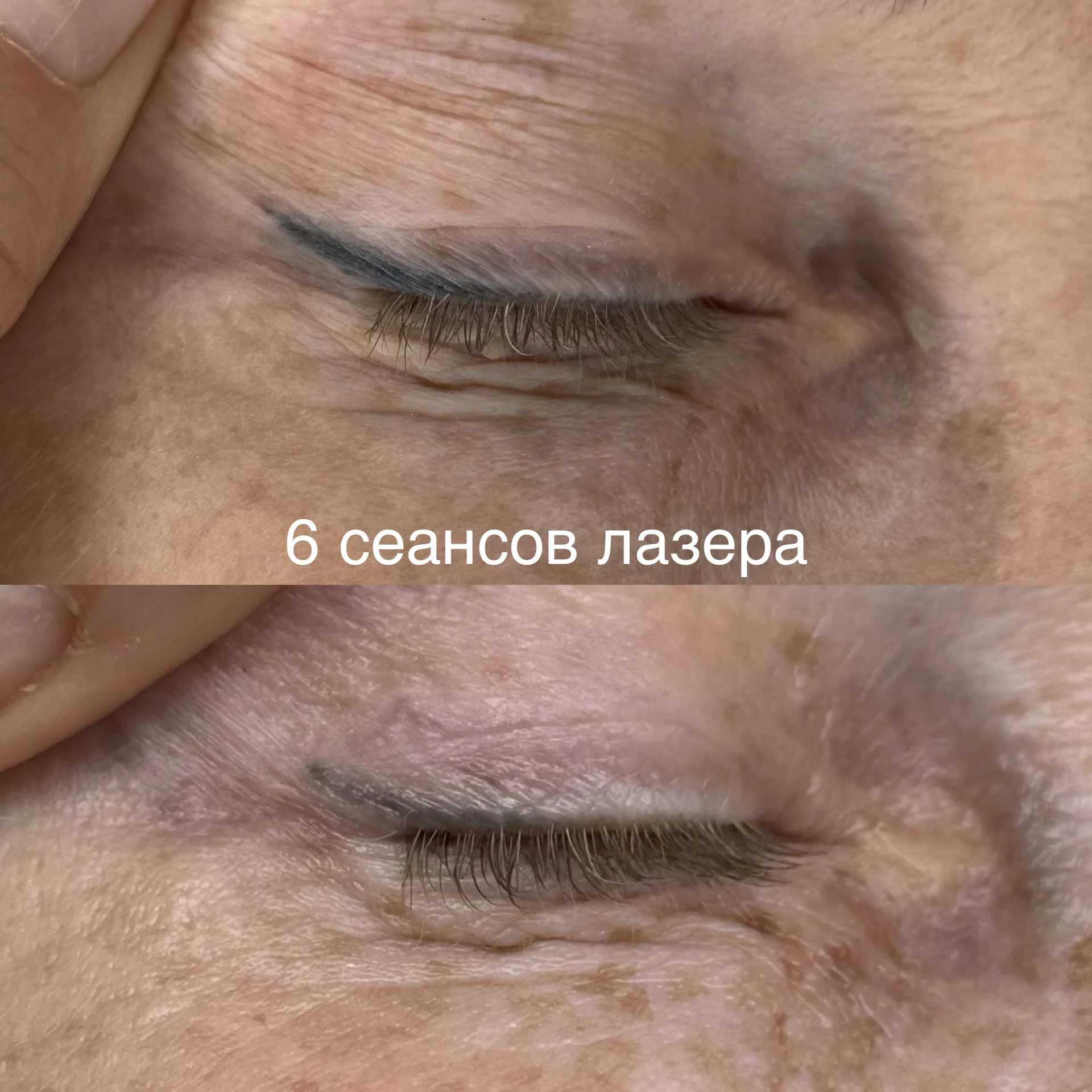 Удаление татуажа - изображение 1