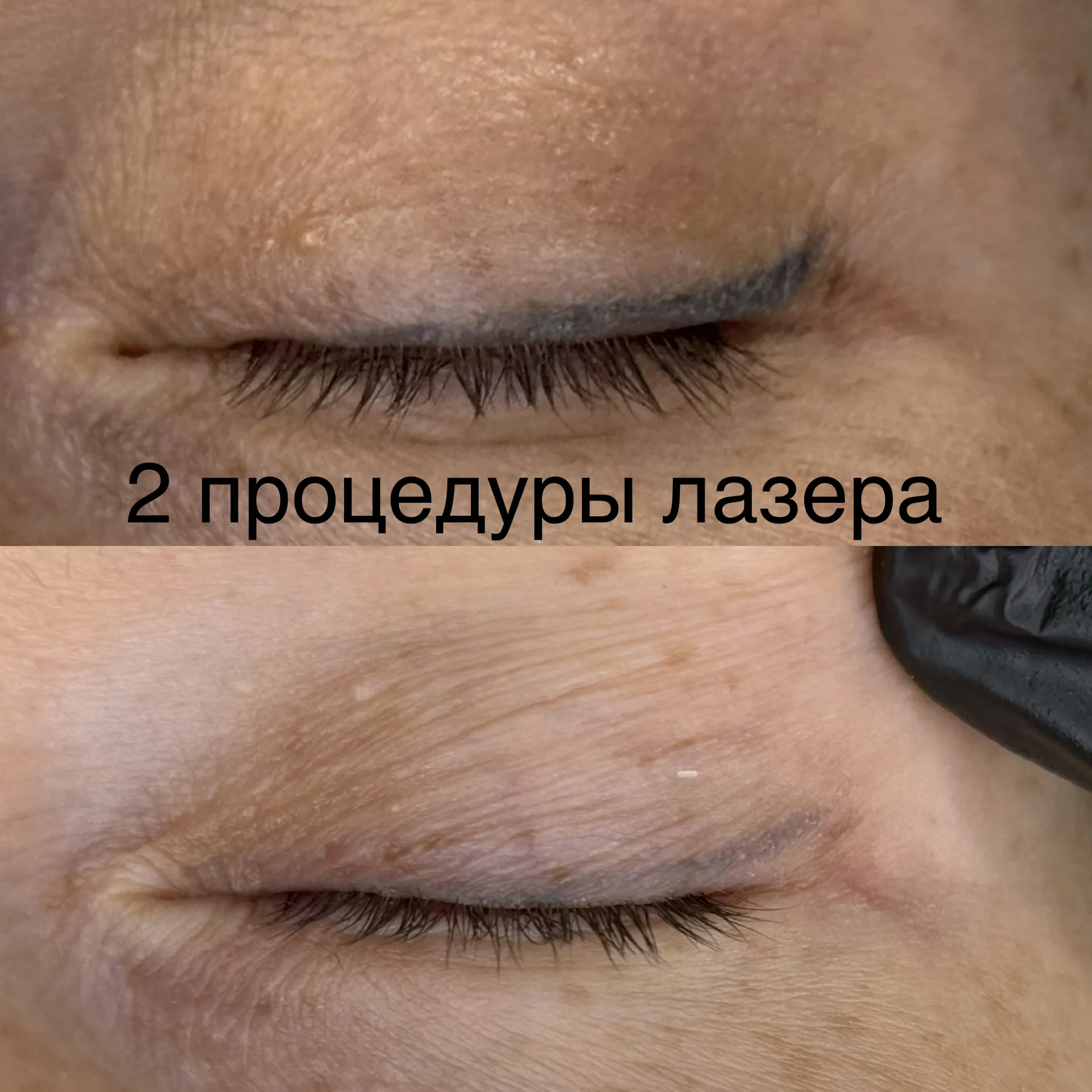Удаление татуажа - миниатюра 4