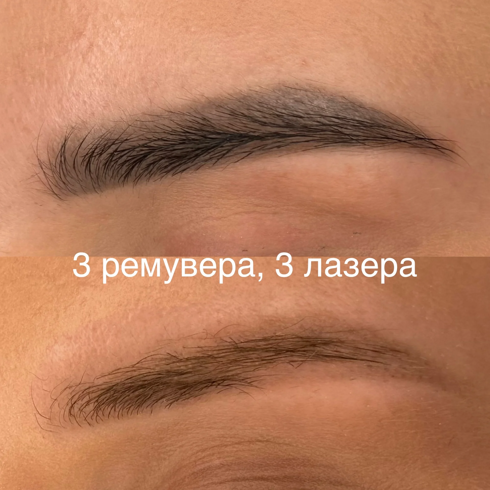 Удаление татуажа - миниатюра 5