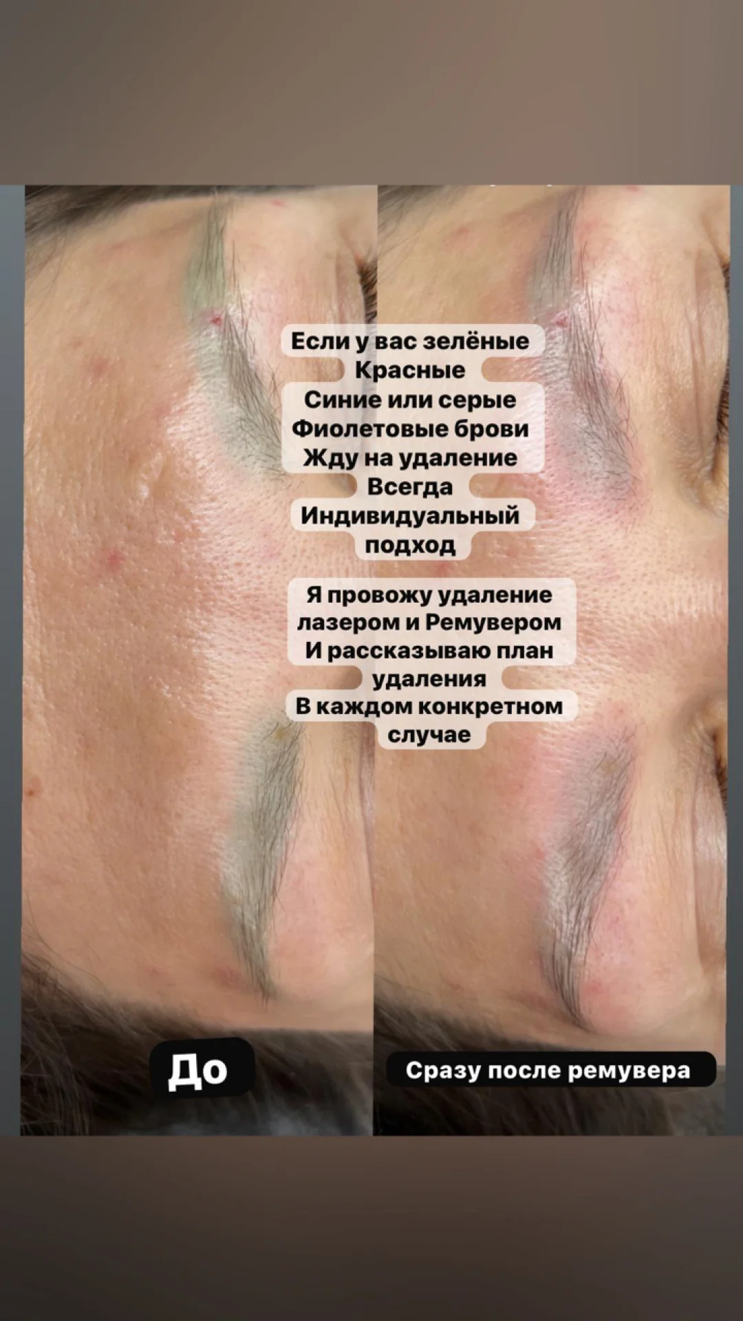 Удаление татуажа - миниатюра 3