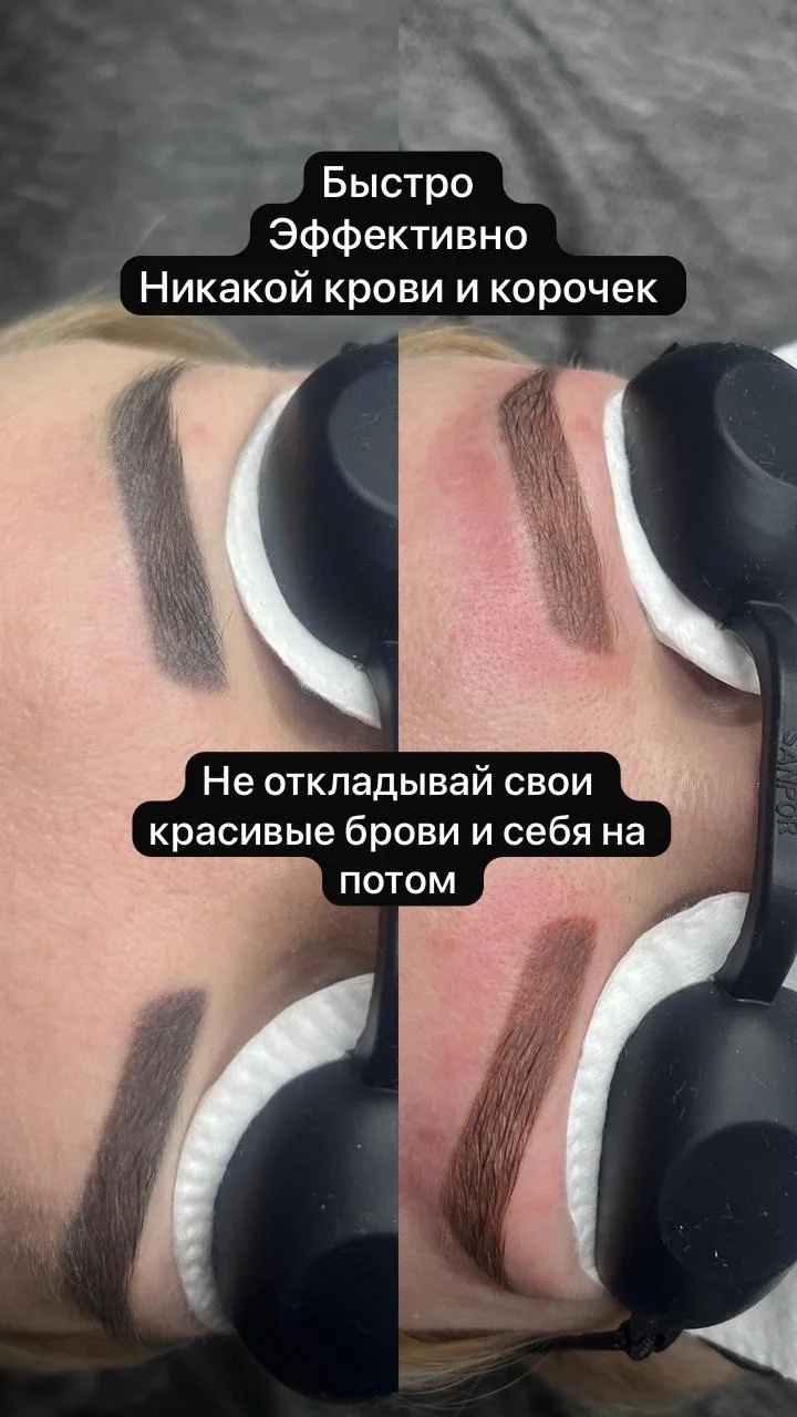 Удаление татуажа - миниатюра 5