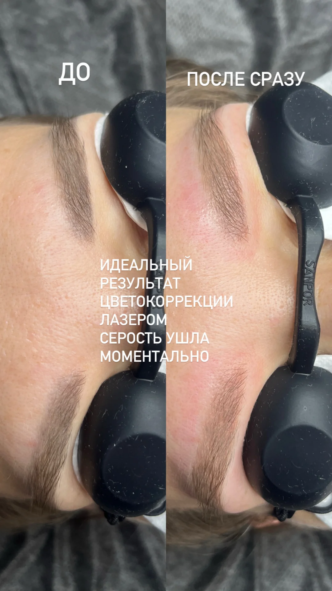 Удаление татуажа - миниатюра 7