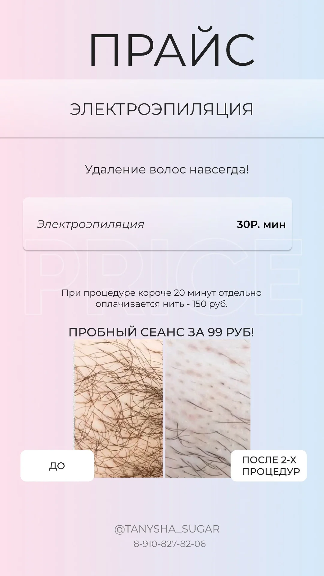 Электроэпиляция, лазерная эпиляция, депиляция - миниатюра 2