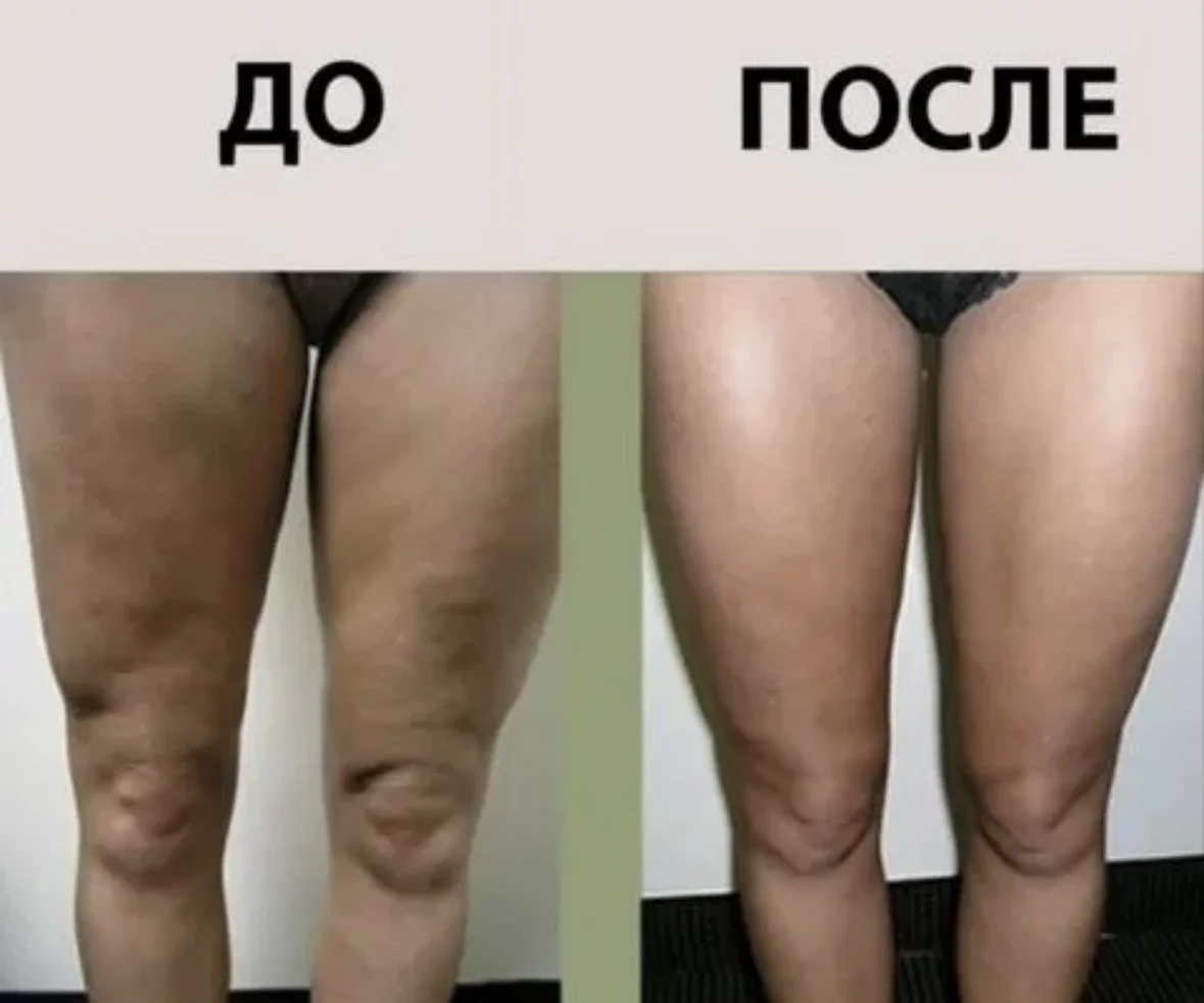 Коррекция фигуры без диет и инъекций - миниатюра 4