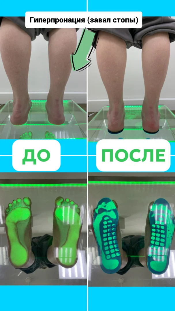 Индивидуальные ортопедические стельки - миниатюра 4