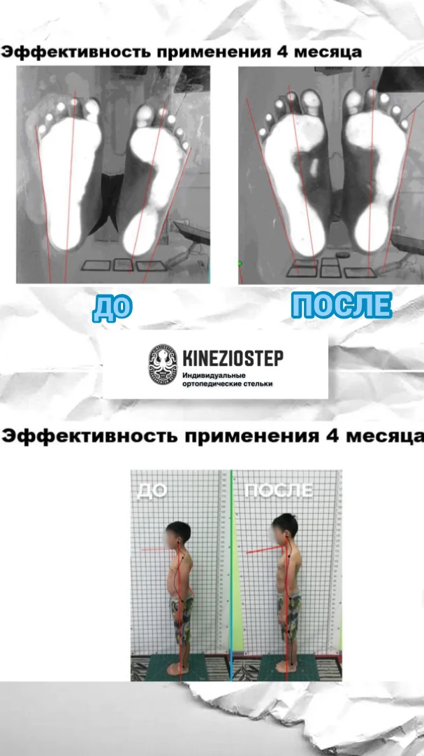Индивидуальные ортопедические стельки - миниатюра 7