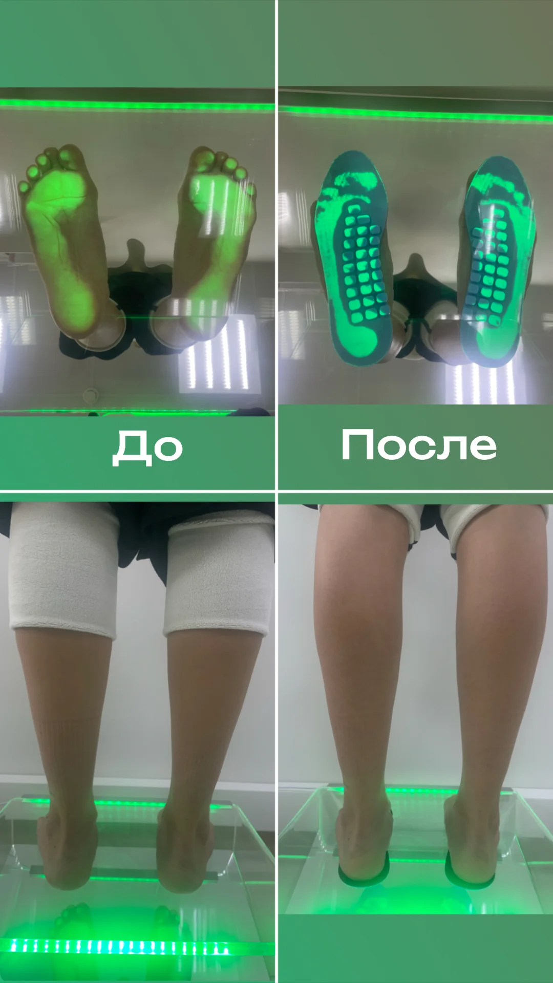 Индивидуальные ортопедические стельки - миниатюра 8