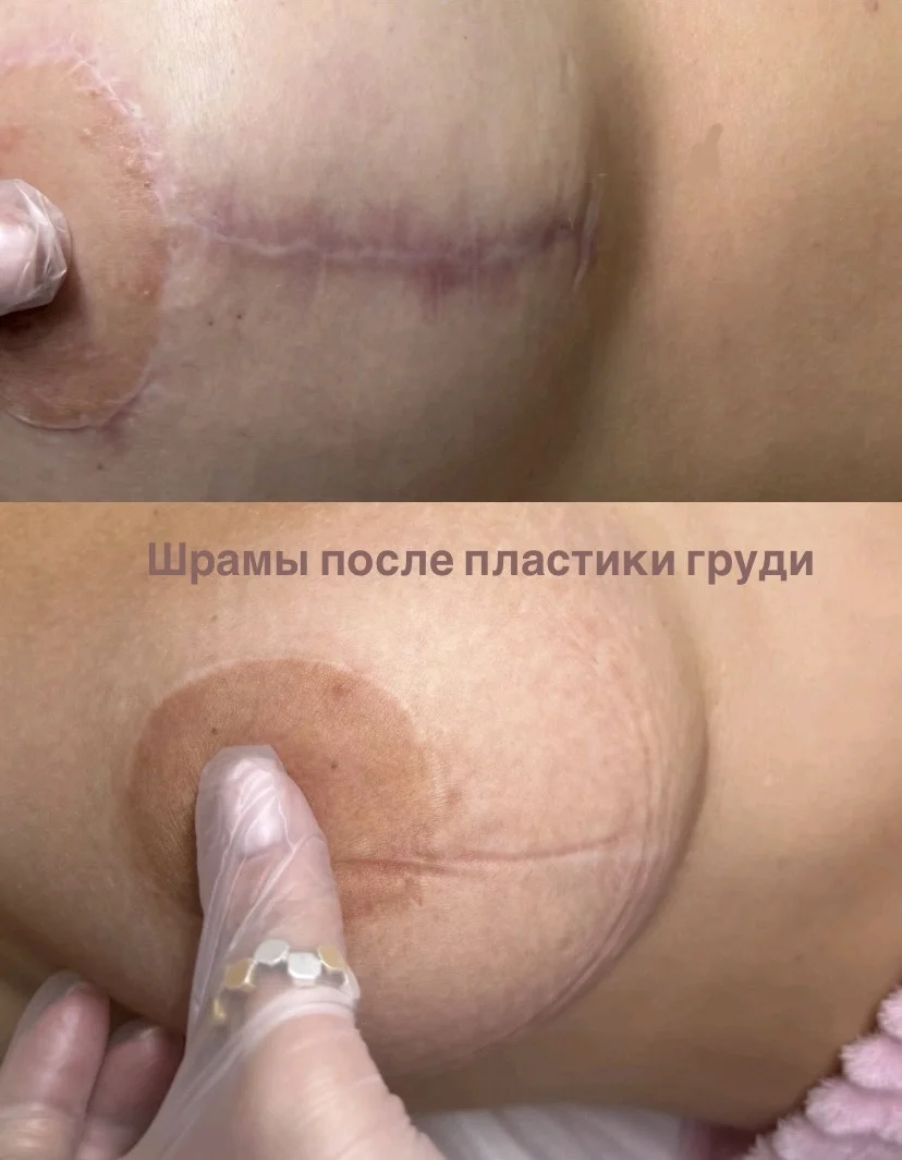 Удаление растяжек и шрамов - миниатюра 4