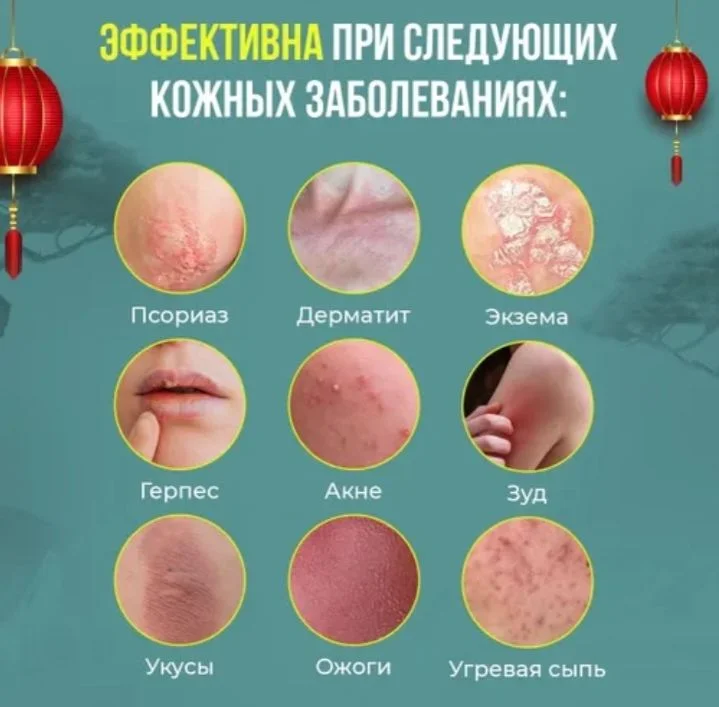 Мазь от псориаза - миниатюра 6