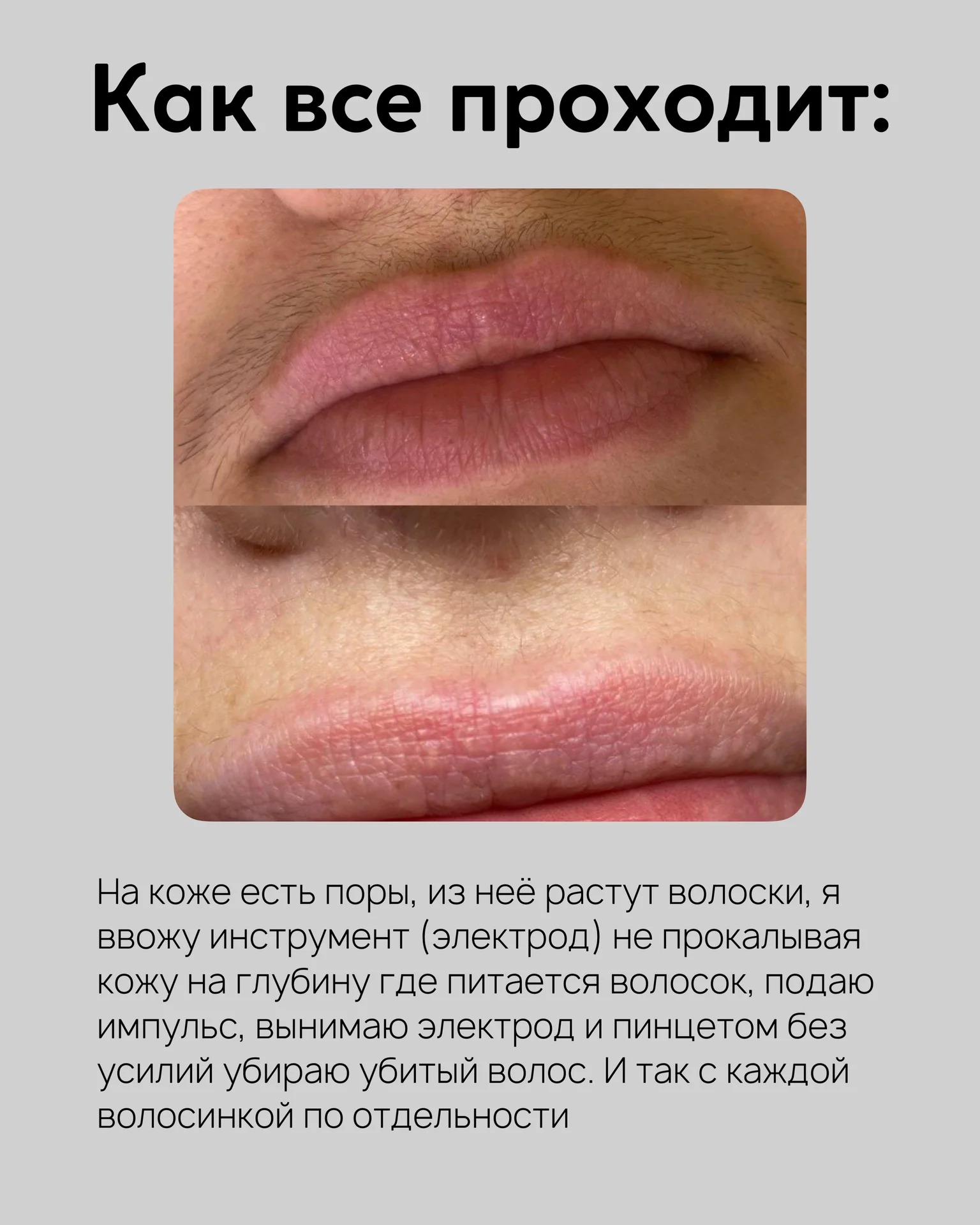 Электроэпиляция - миниатюра 3