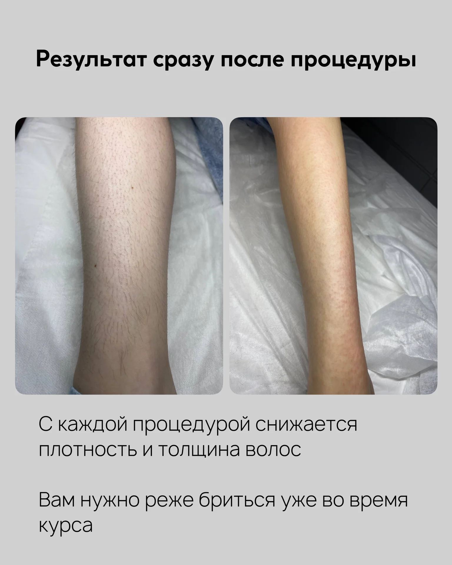 Электроэпиляция - миниатюра 4