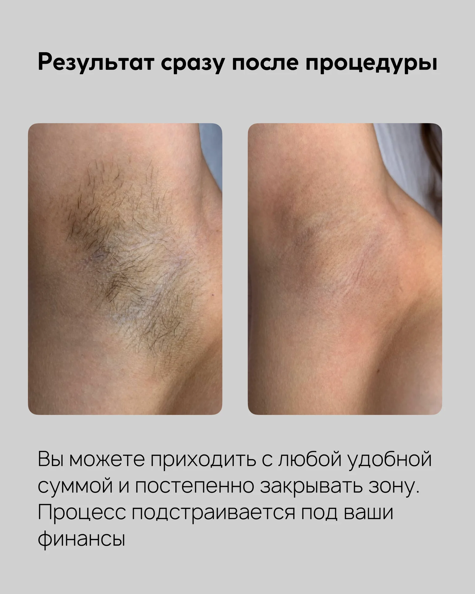 Электроэпиляция - миниатюра 5