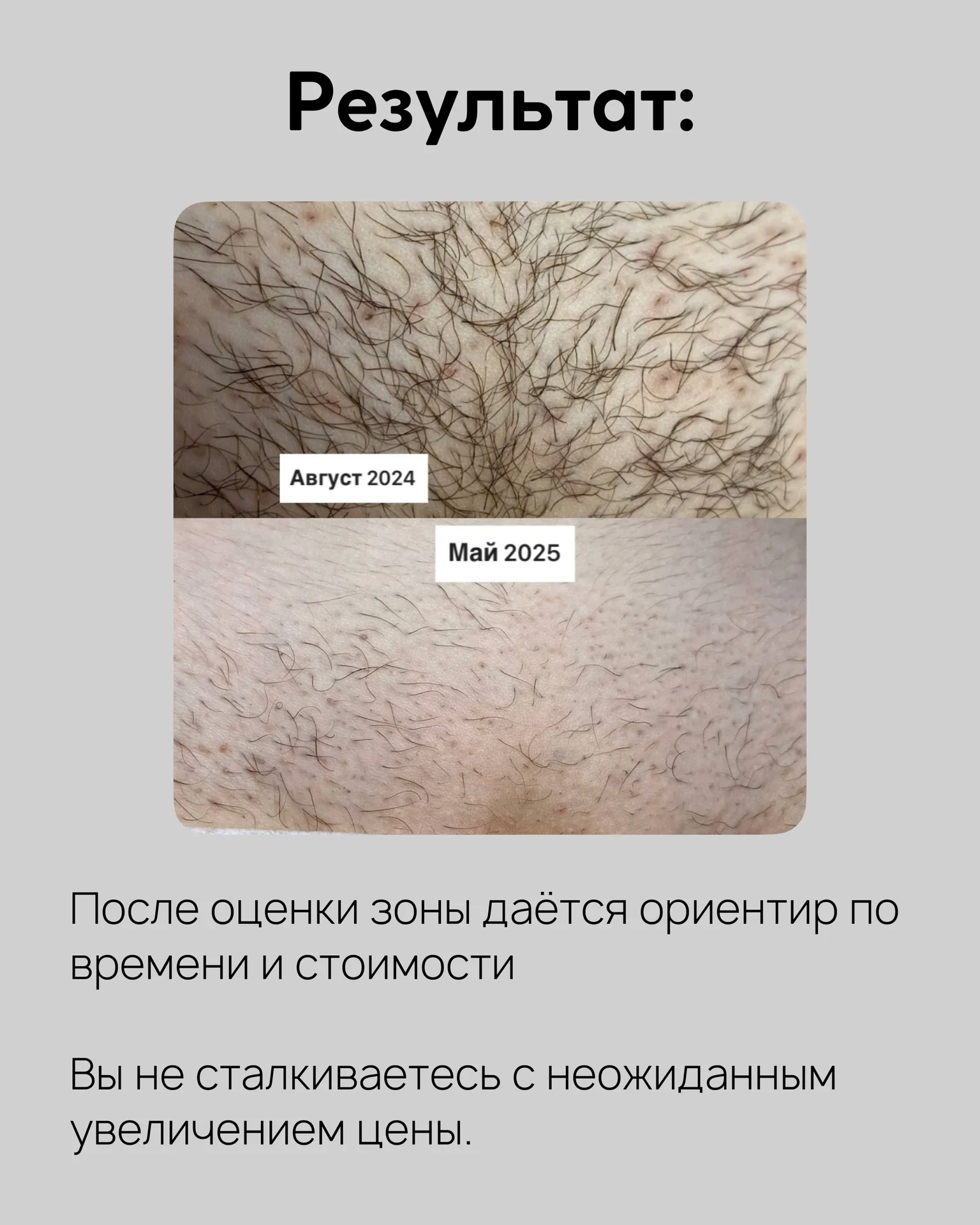 Электроэпиляция - миниатюра 6