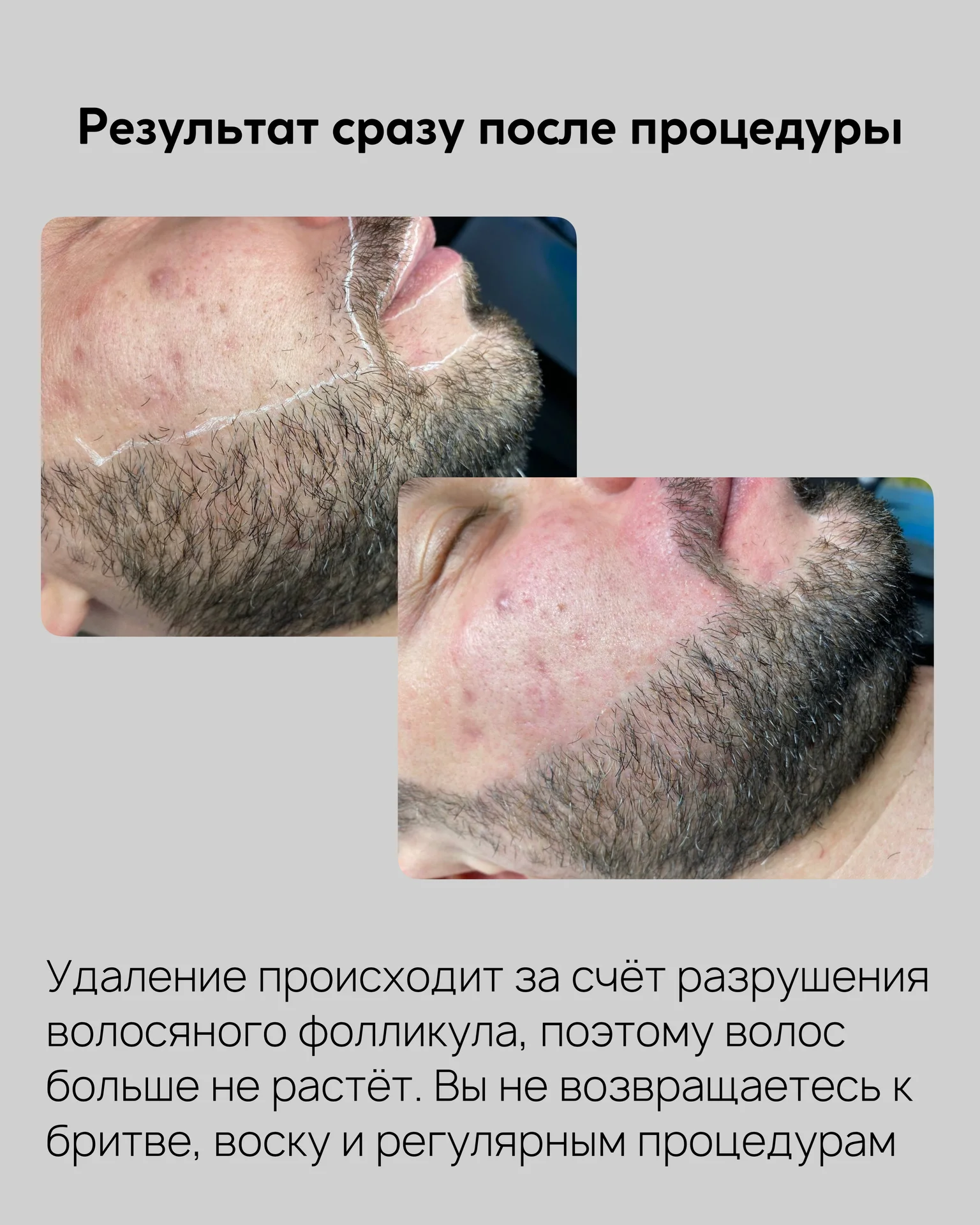 Электроэпиляция - миниатюра 7