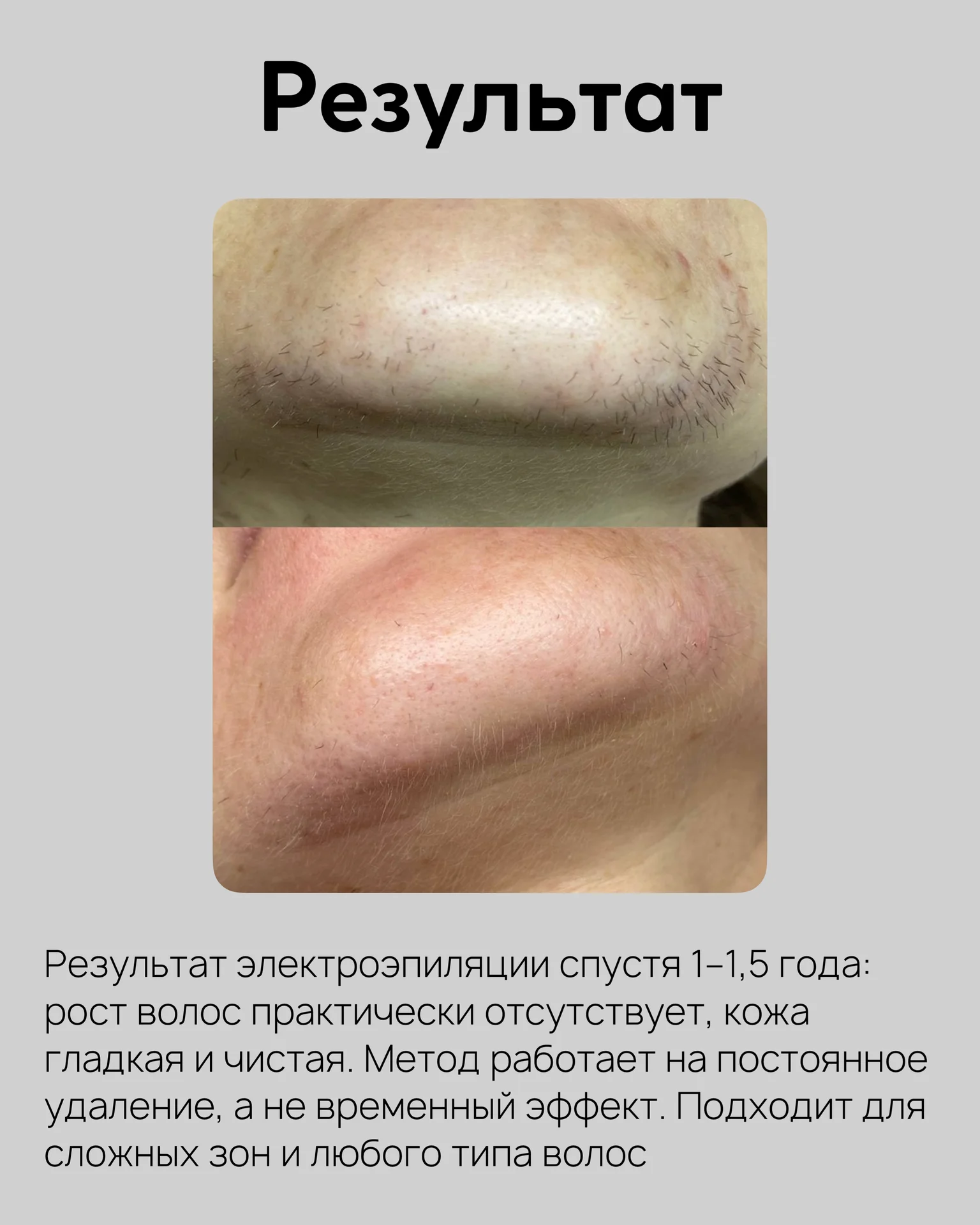 Электроэпиляция - миниатюра 8
