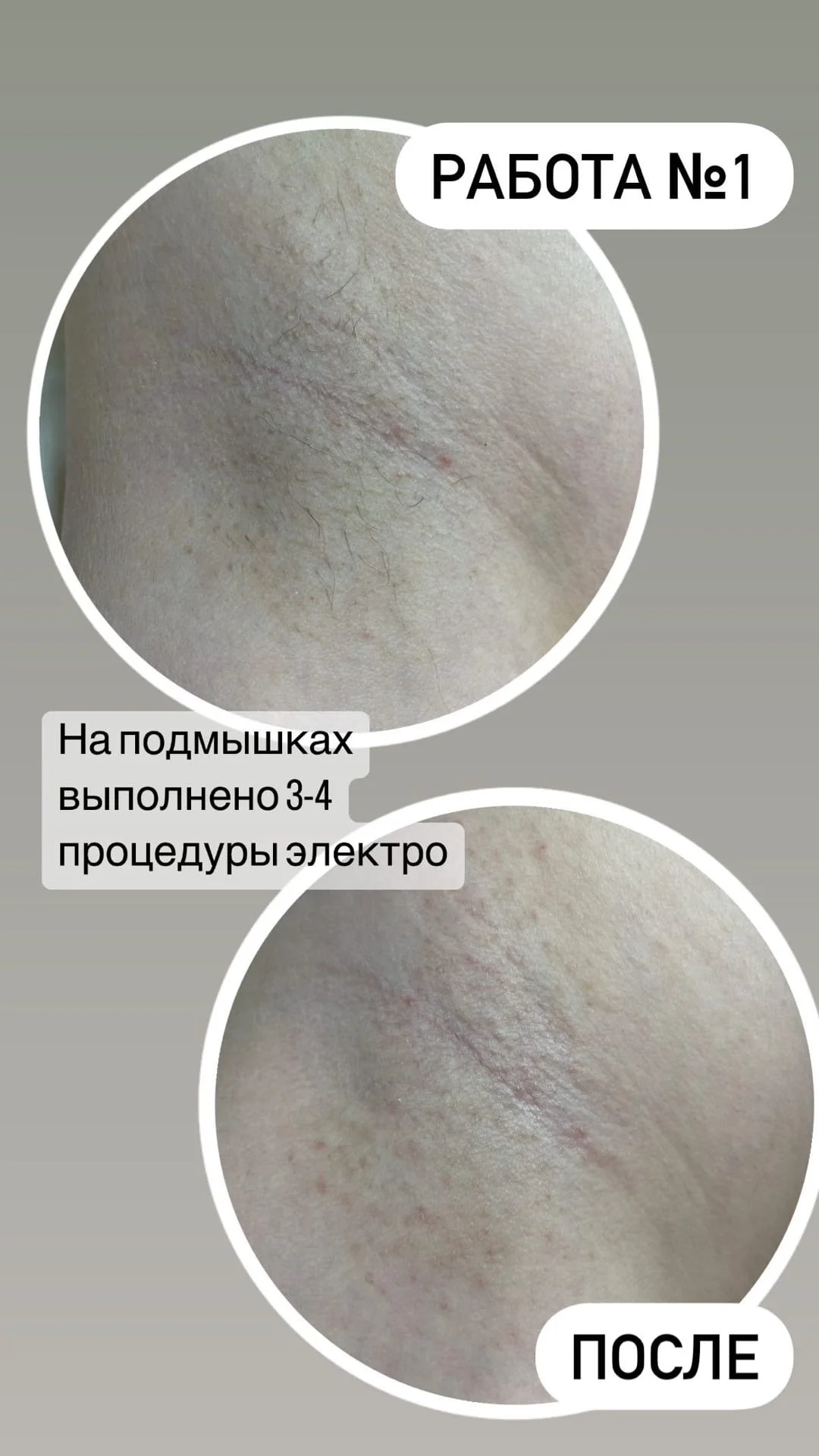 Электроэпиляция - миниатюра 4