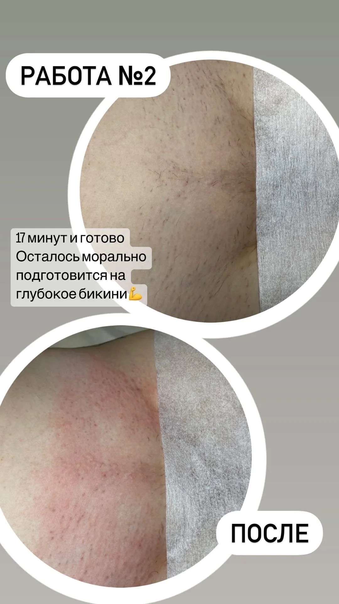 Электроэпиляция - миниатюра 5