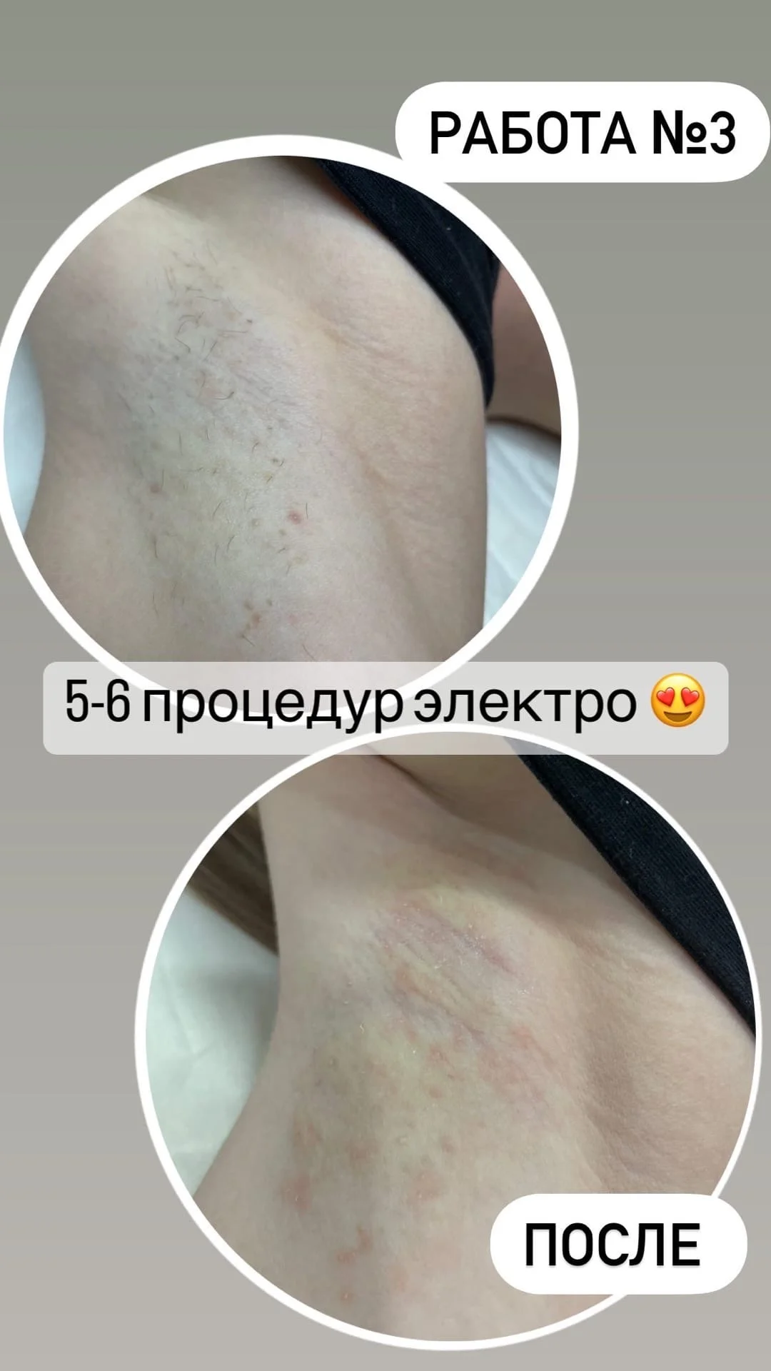 Электроэпиляция - миниатюра 6