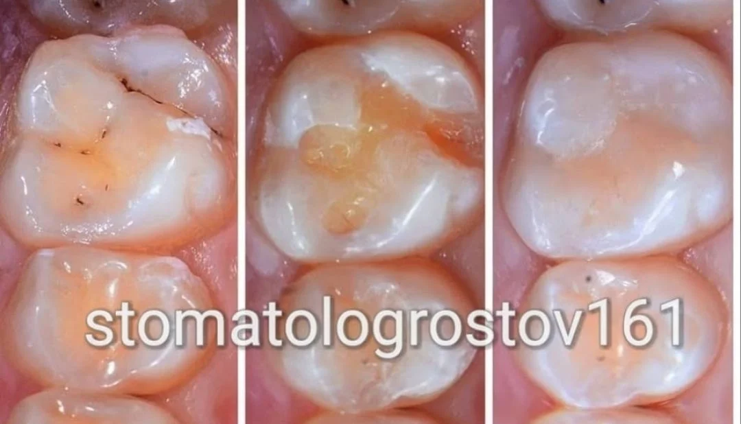 Чистка зубов  Отбеливание Удаление Имплантация - миниатюра 4