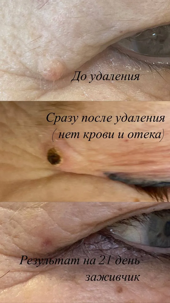 Удаление папиллом, родинок, бородавок - миниатюра 3