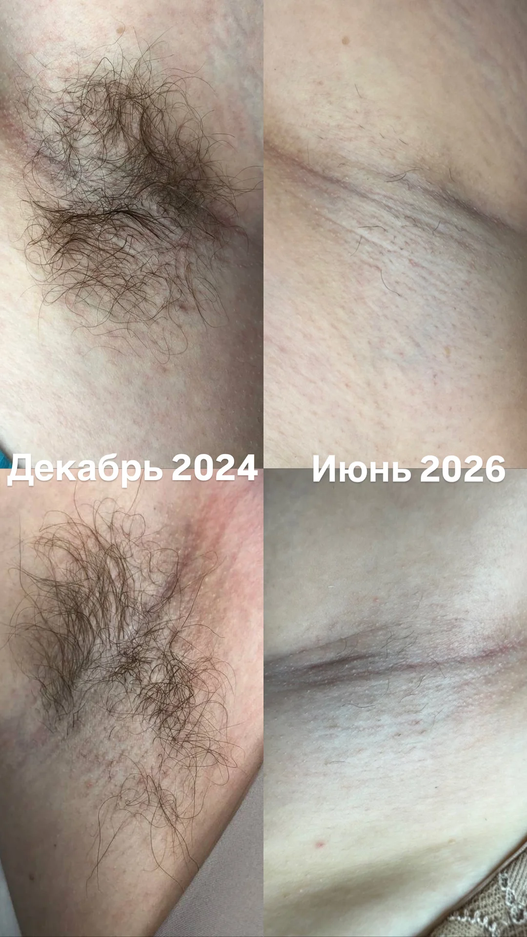 Электроэпиляция удаление волос навсегда - миниатюра 4
