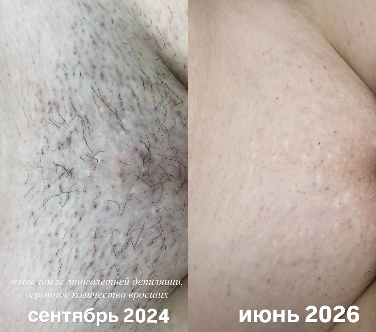 Электроэпиляция удаление волос навсегда - миниатюра 5