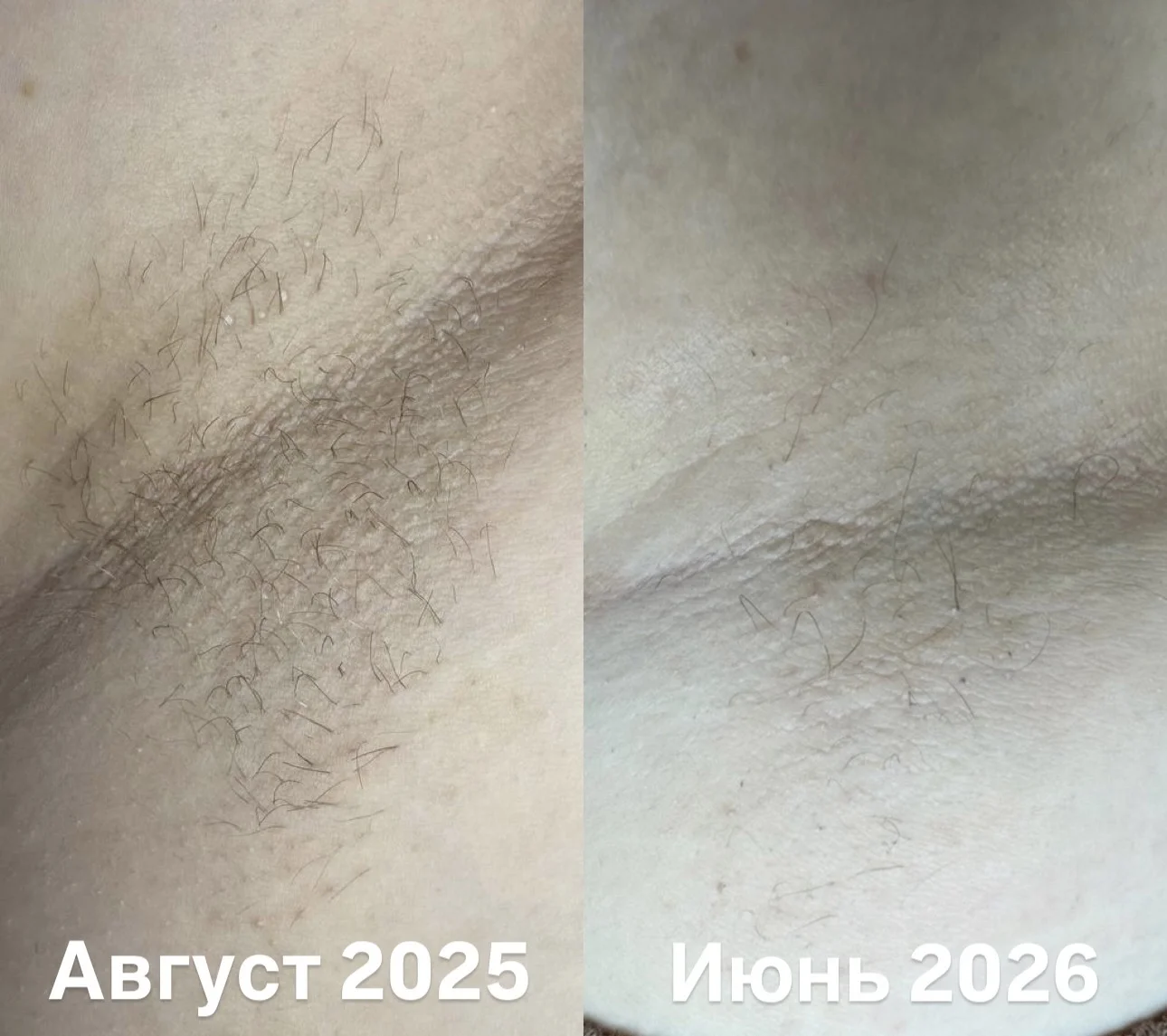 Электроэпиляция удаление волос навсегда - миниатюра 9