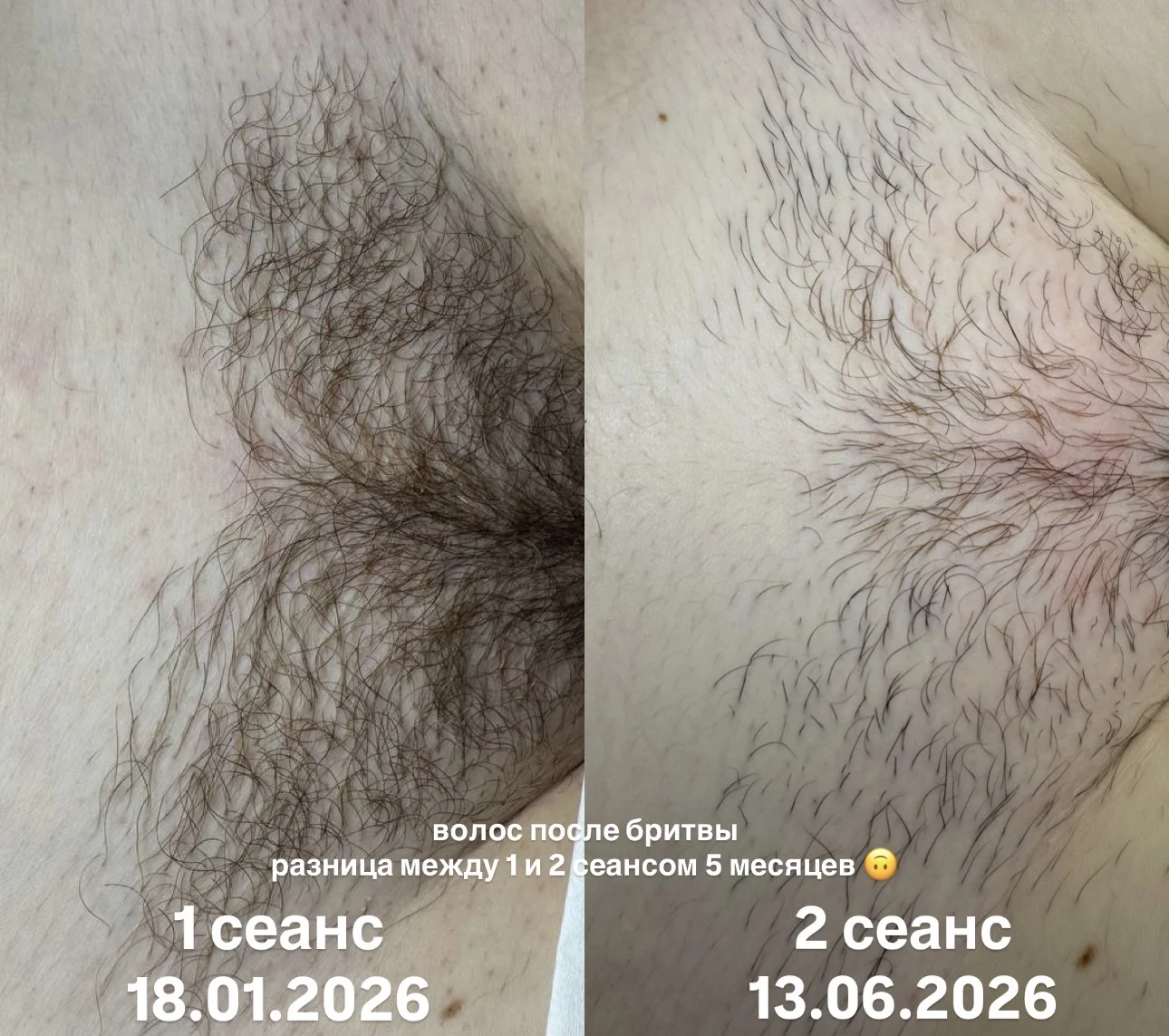 Электроэпиляция удаление волос навсегда - миниатюра 10