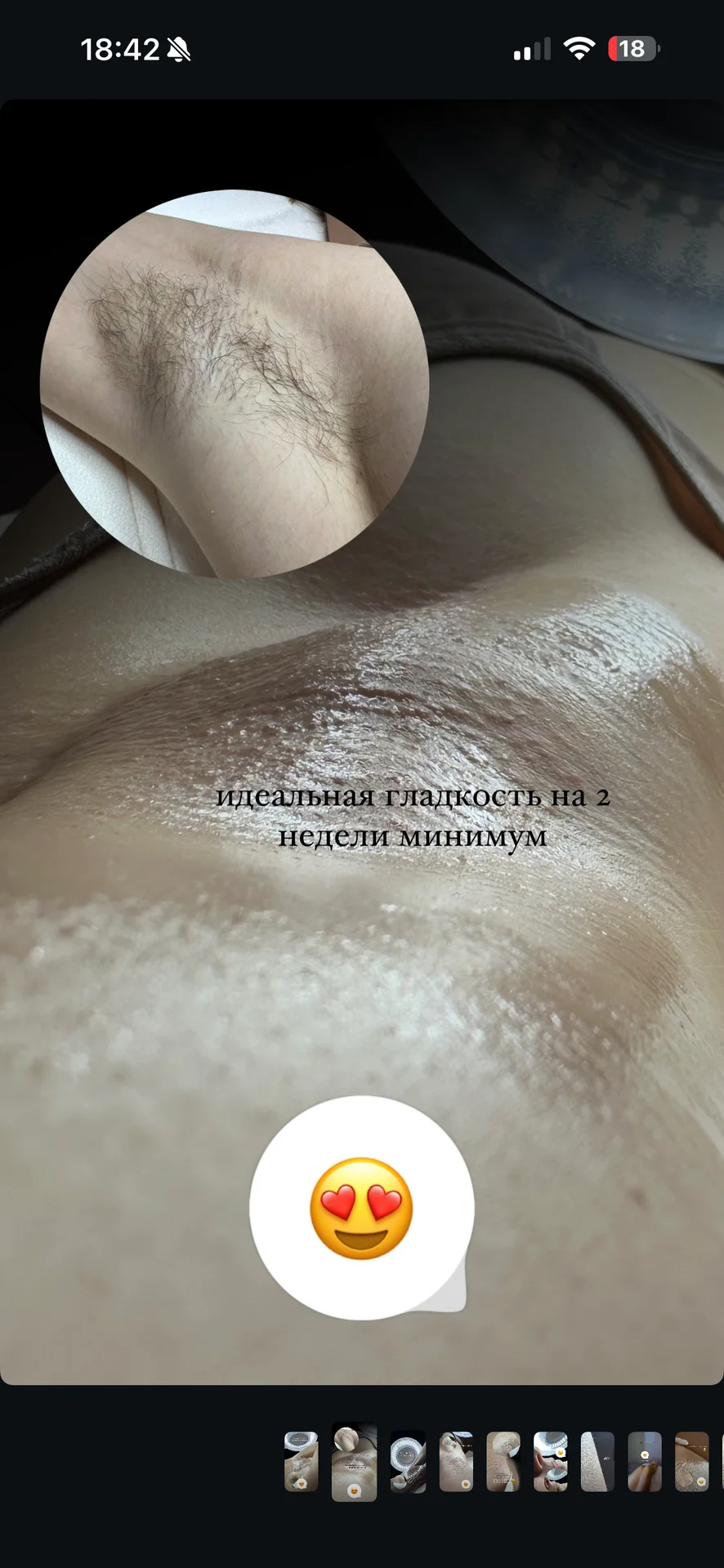 Лазерная эпиляция Шугаринг Обучение Ростов-на-Дону - миниатюра 7