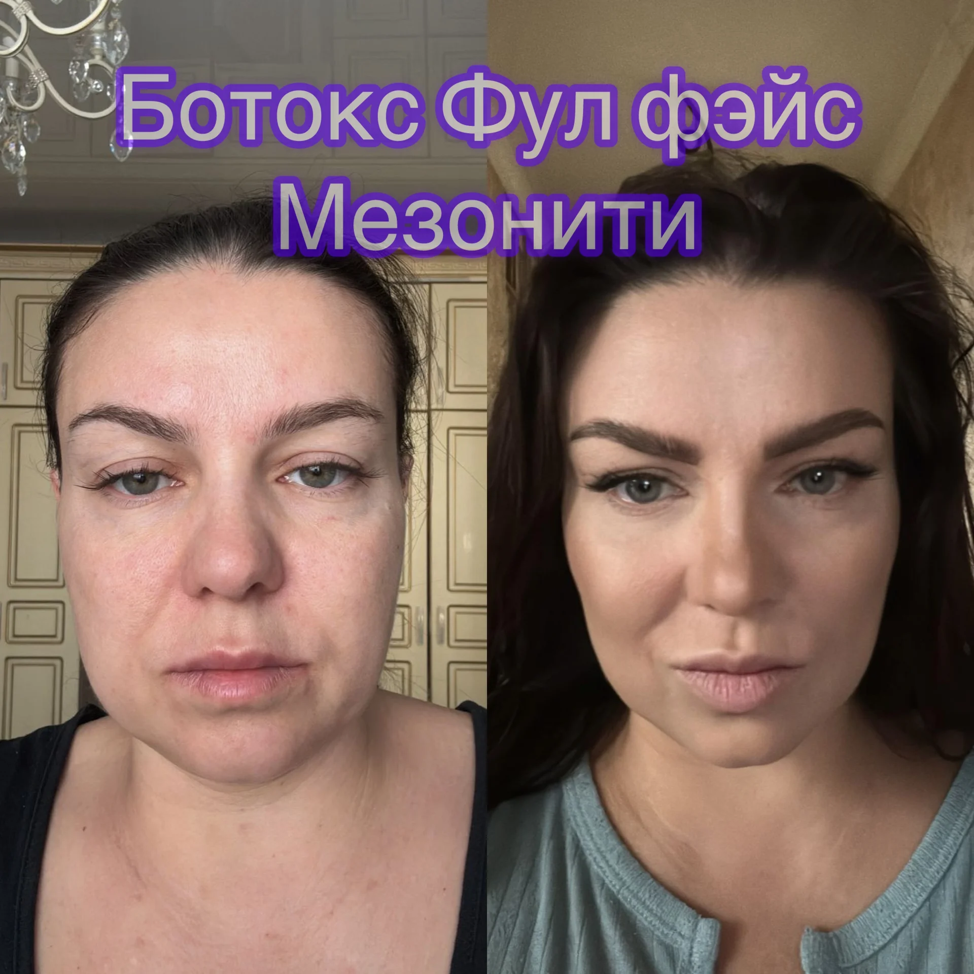 Ботокс нити  инъекции косметолог - миниатюра 4