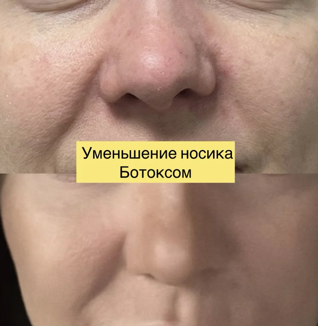 Ботокс нити  инъекции косметолог - миниатюра 6