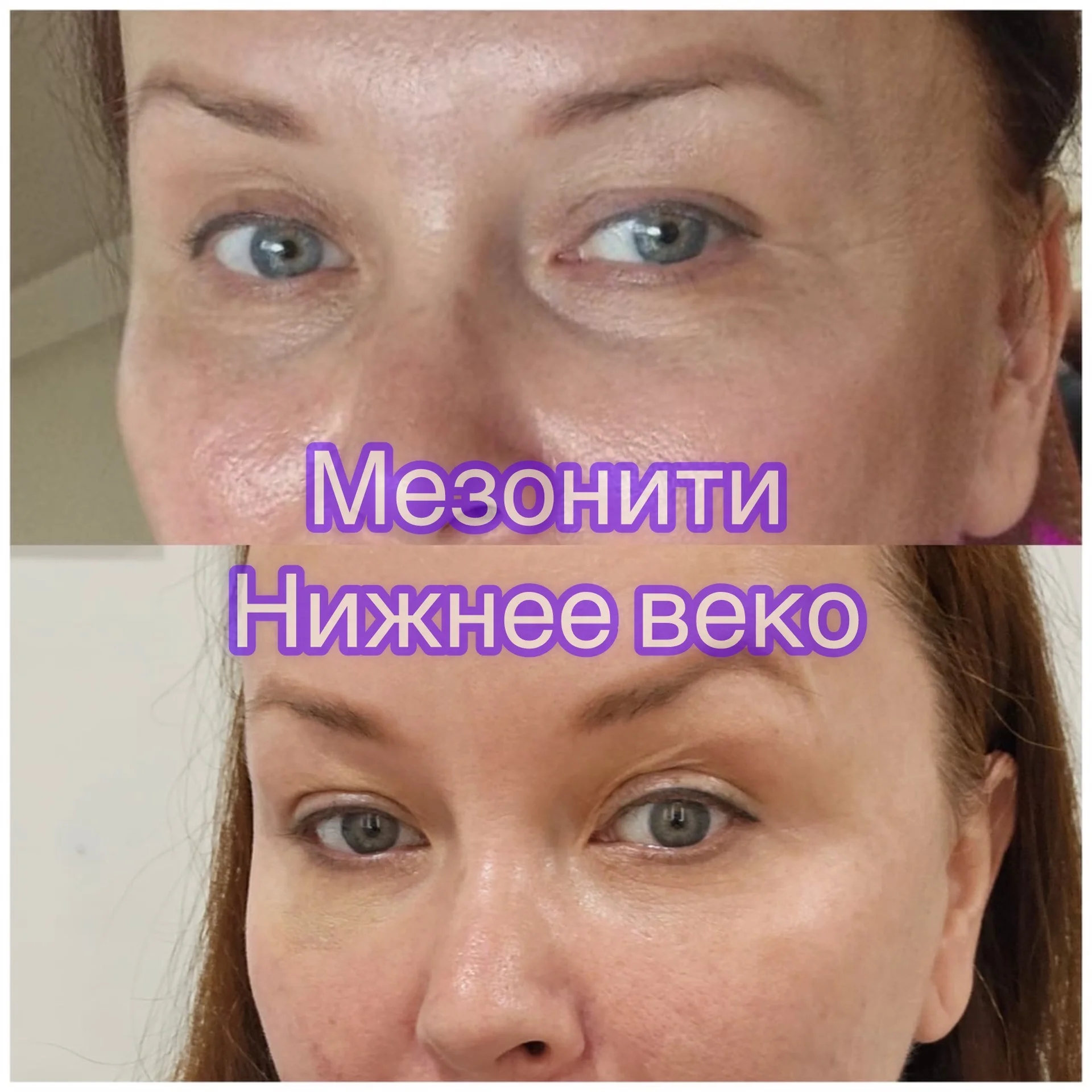 Ботокс нити  инъекции косметолог - миниатюра 7