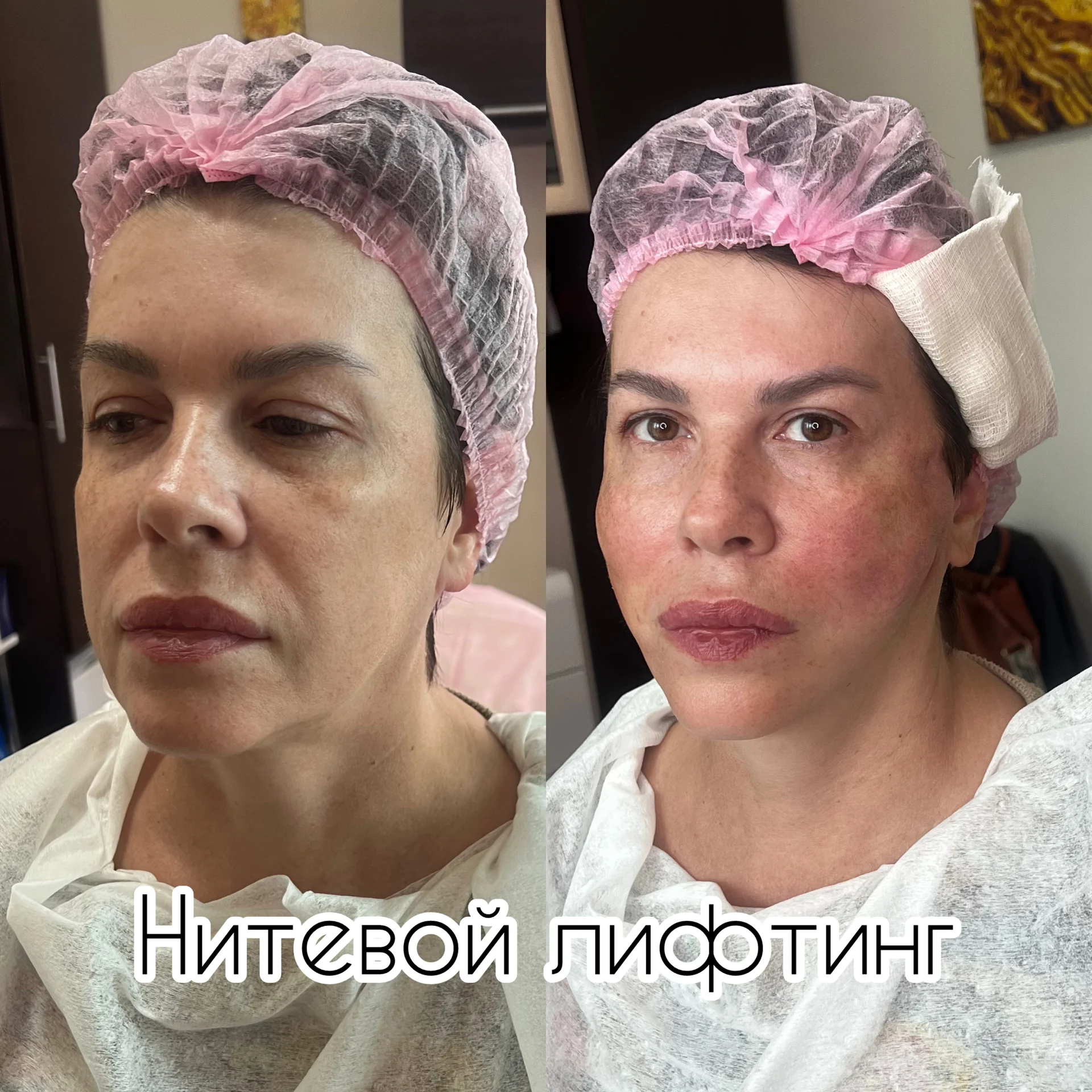 Ботокс нити  инъекции косметолог - миниатюра 10