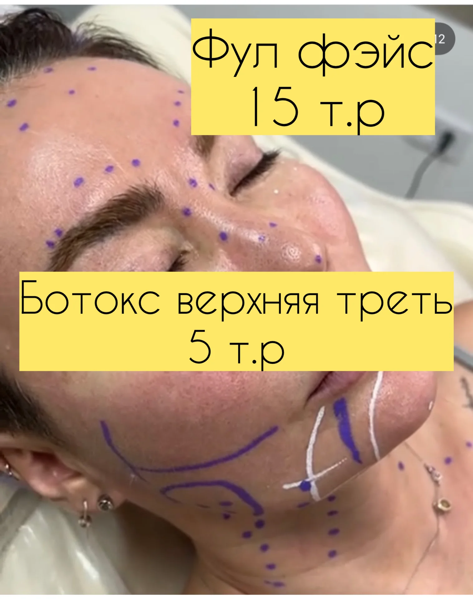 Ботокс нити  инъекции косметолог - миниатюра 14